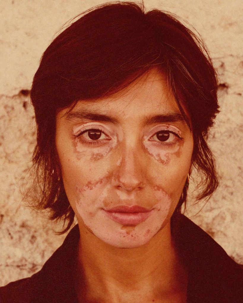 Portrait d'une femme avec un vitiligo